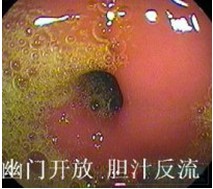 胆汁反流性胃炎